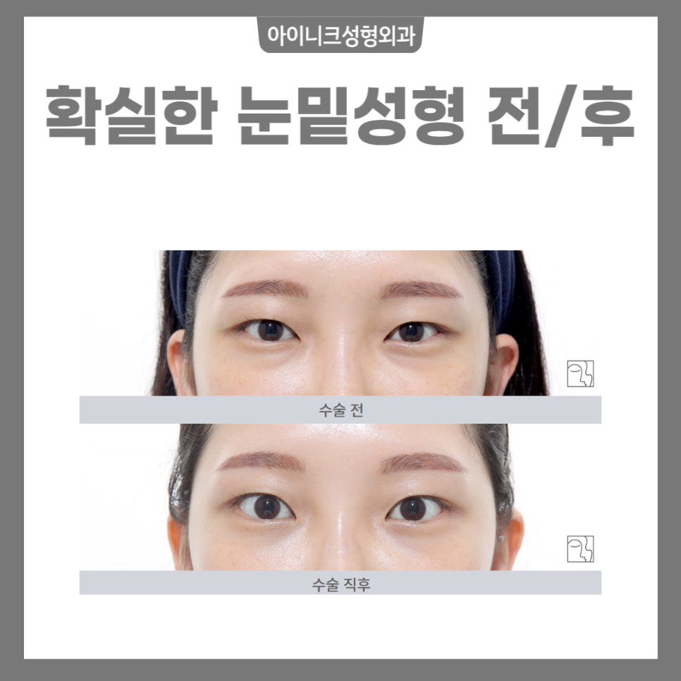 눈밑성형 더욱 젊고 자신있게 유스앤영 X 아이니크 관련 이미지 4