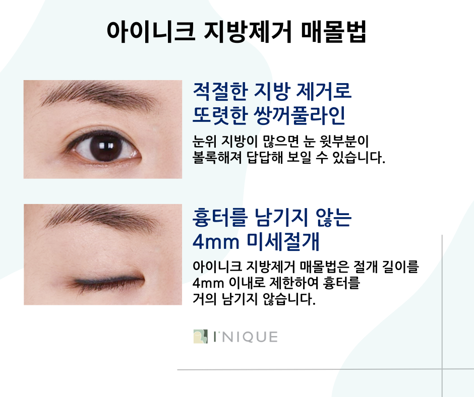 압구정쌍수 성공하는 방법 궁금하다면 관련 이미지 6