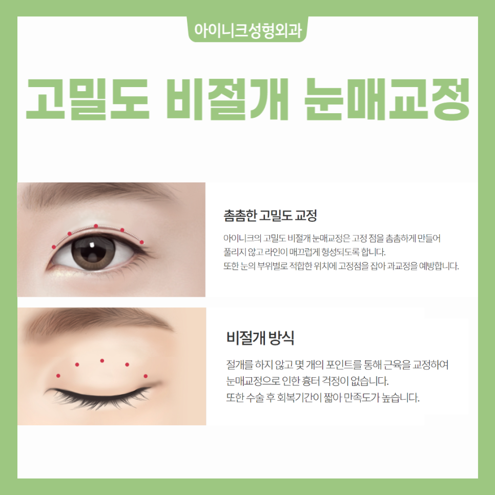 졸린눈수술로 또렷한 눈매를 만들자! 관련 이미지 6