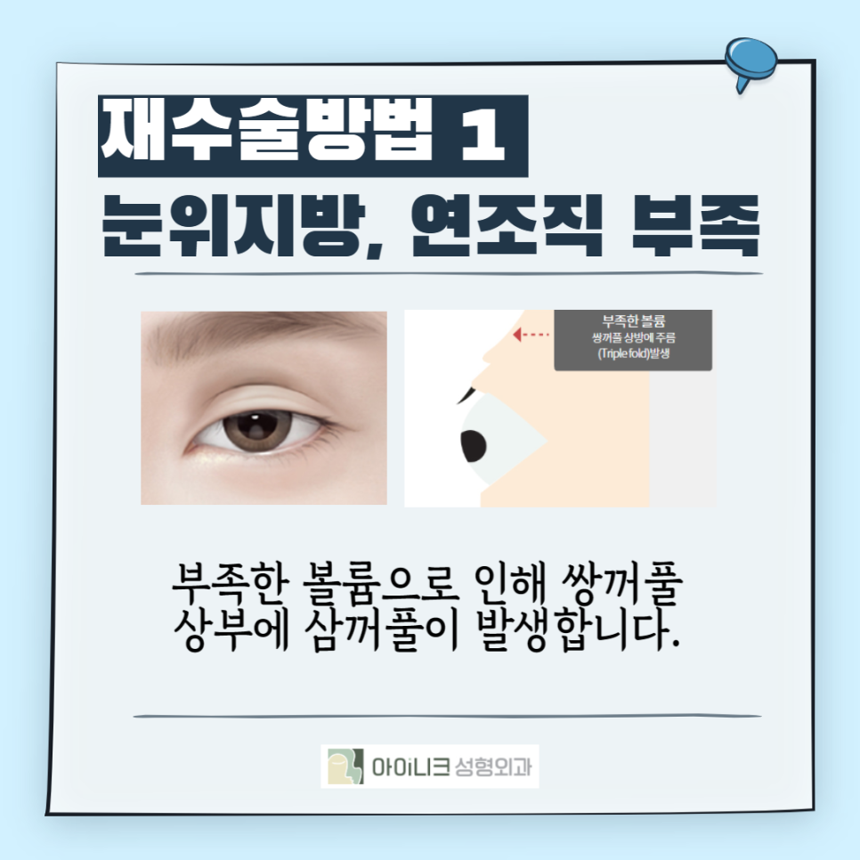 겹쌍꺼풀수술이고민이라면? 관련 이미지 4