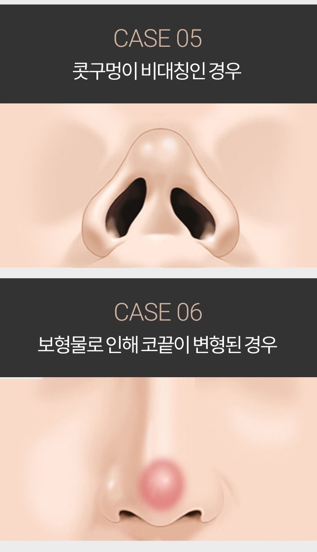 코재건수술 두 번의 실수는 없다! 관련 이미지 5