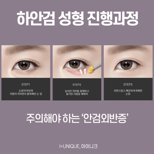 중년눈성형방법, 안전하고 완벽하게! 관련 이미지 4
