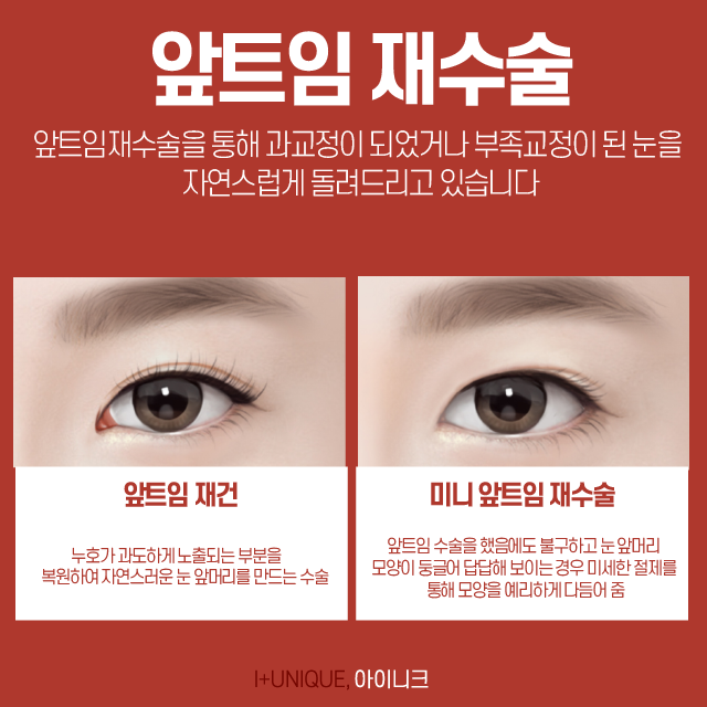 성형눈재수술, 보다 신중한 병원결정이 필요한 이유 관련 이미지 5