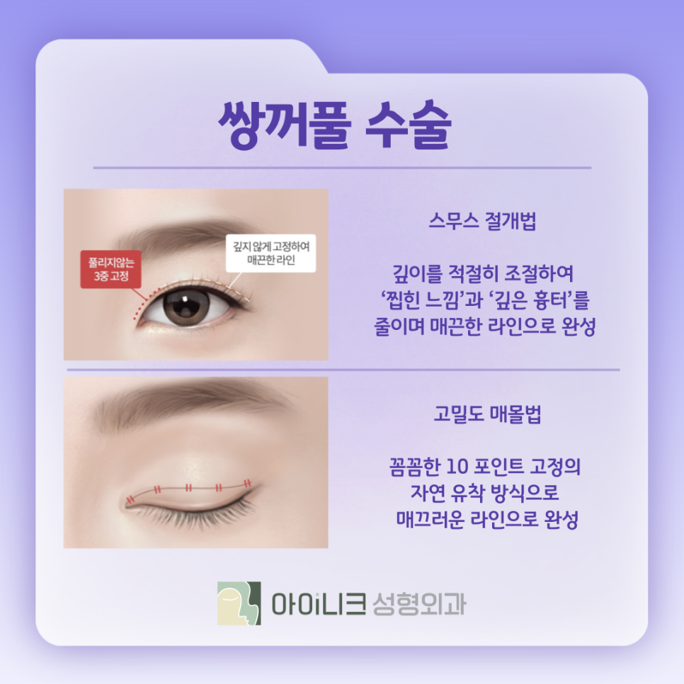 눈수술종류 내게 맞는 방법은 무엇? 관련 이미지 4