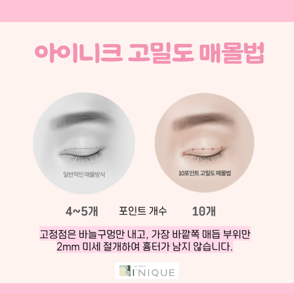 자연스러운 쌍수를 위한 중요한 점 관련 이미지 3