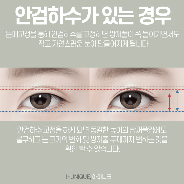 눈재수술병원을 알아보고 있다면, 신중해야 하는 이유 관련 이미지 4
