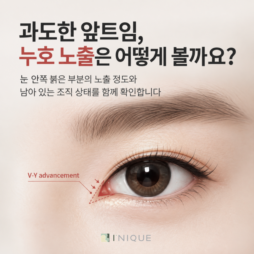 앞트임 재수술 복원 기간, 얼마나 기다려야 할까요? 관련 이미지 4