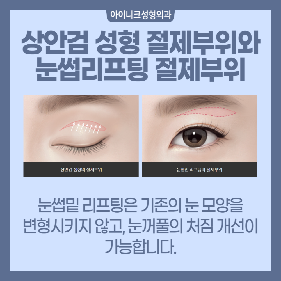 중년눈성형 고민이라면? 관련 이미지 3