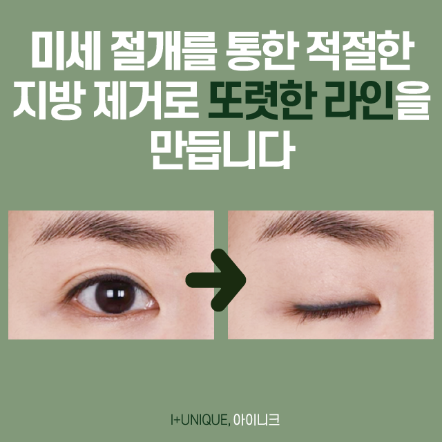흑역사 없는 졸업사진 찍는 법? 아이니크의 눈쌍꺼풀수술! 관련 이미지 4