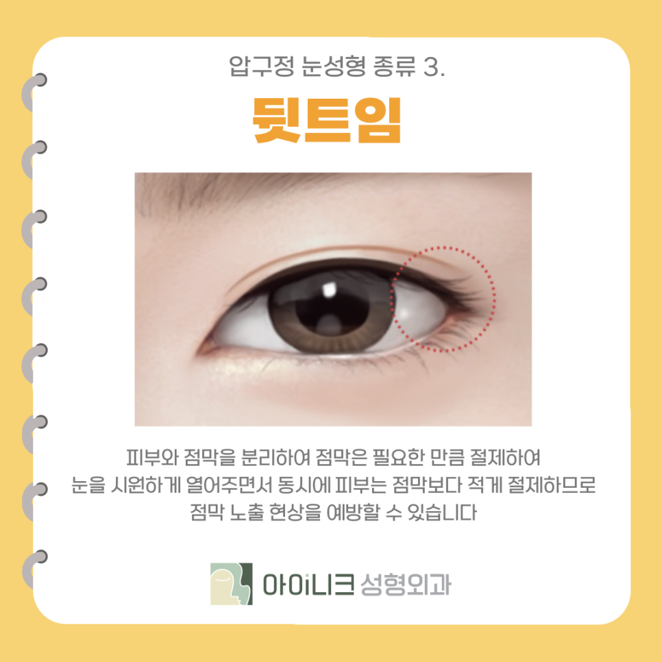 Types of Eye Surgery in Apgujeong: Making the Eye Shape Clearer and Brighter with Canthoplasty image 6