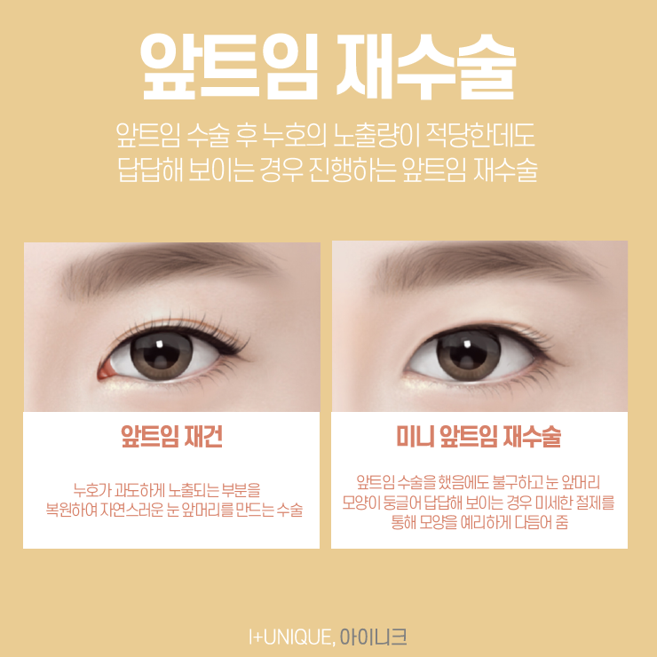 앞트임잘하는곳은 바로 여기! 아이니크성형외과 관련 이미지 5
