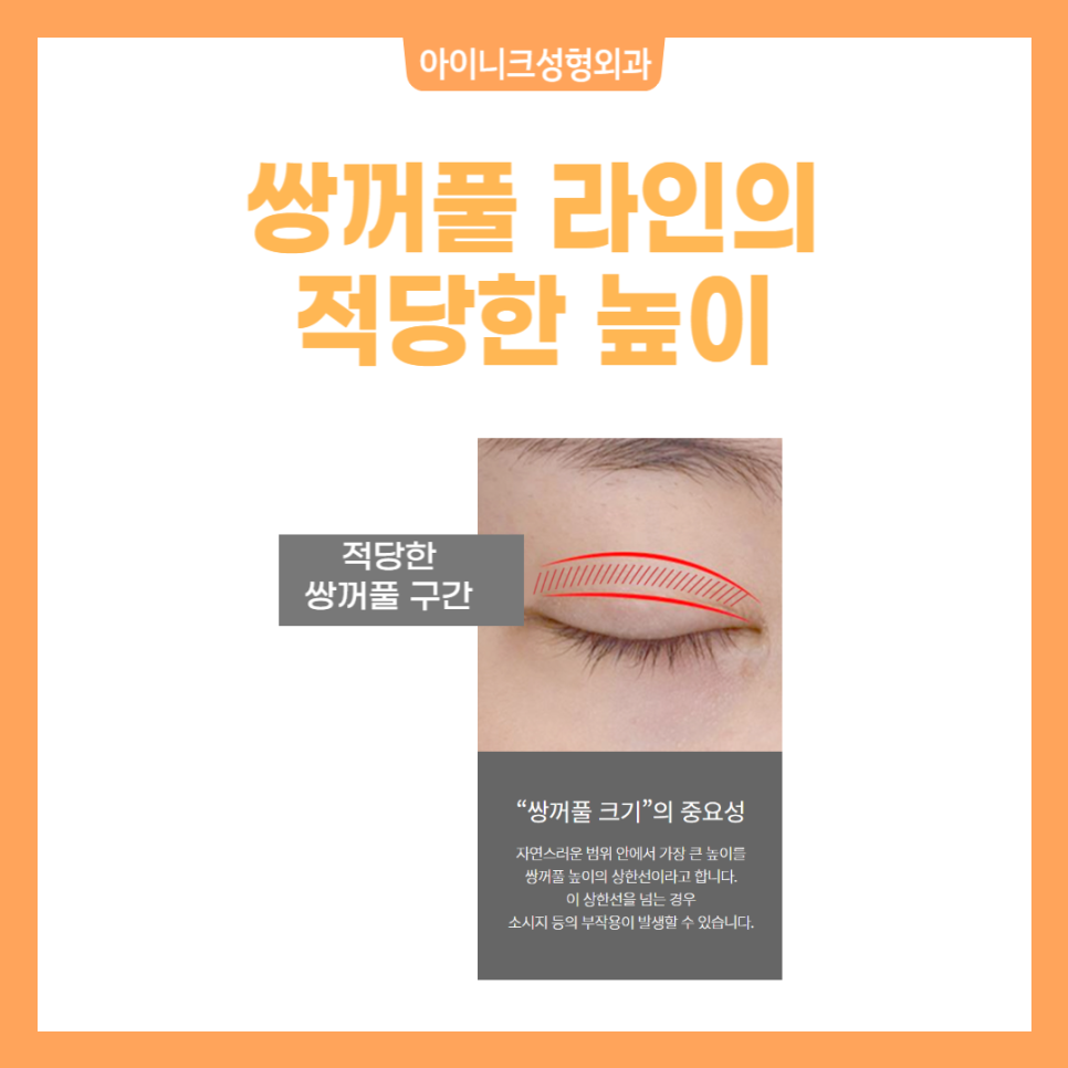 남자눈성형 한지 모를 정도의 자연스러움 관련 이미지 3
