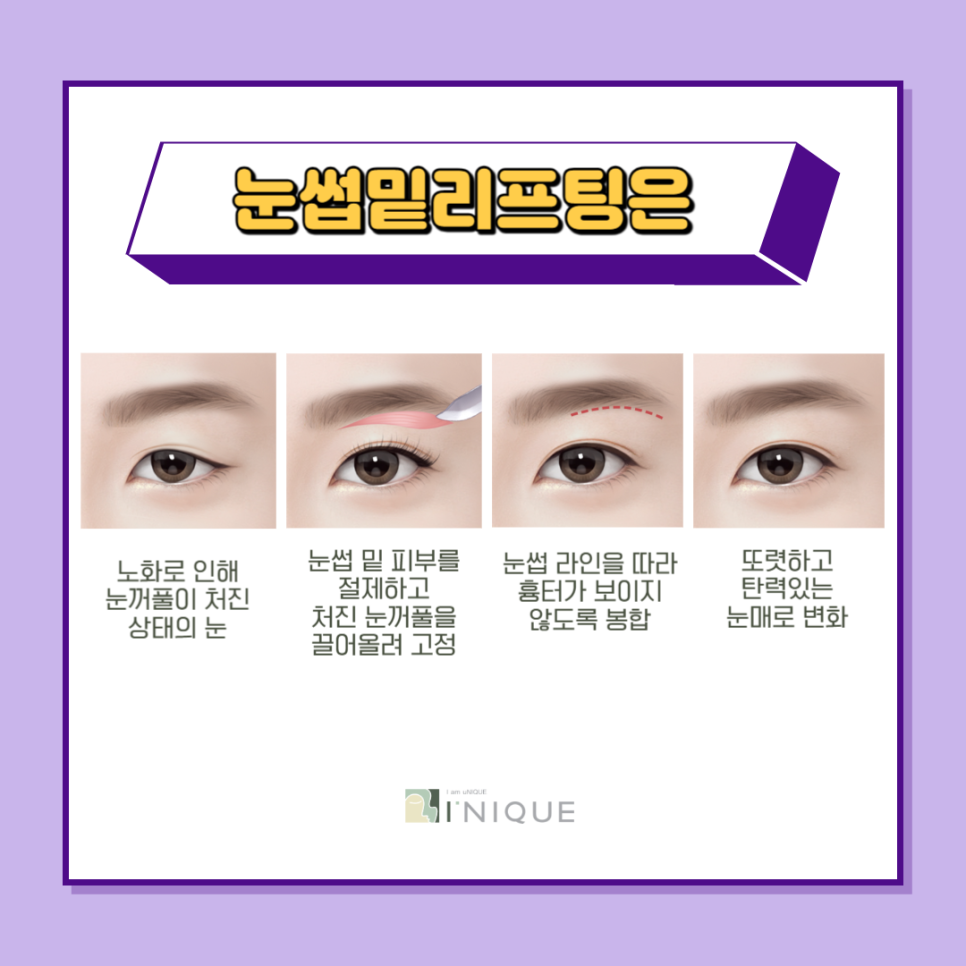 동안눈성형으로 자신감 회복 관련 이미지 3