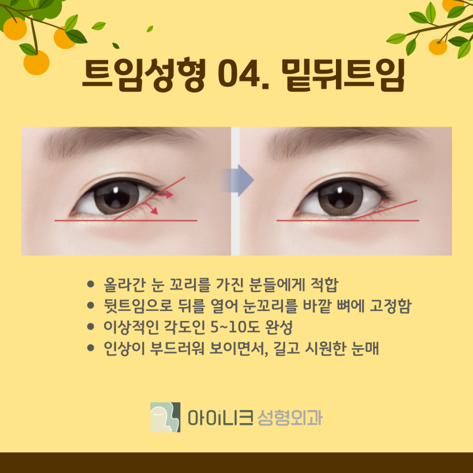 눈트임 수술 종류 나에게 맞는 방법은? 관련 이미지 11