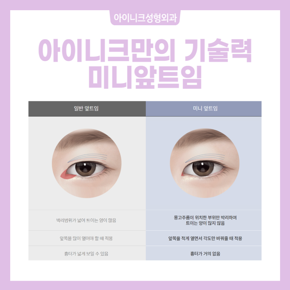 눈트임성형 자연스럽고 아름답게! 관련 이미지 3