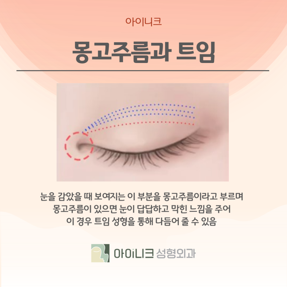 압구정성형외과 앞트임으로 크고 예쁜 눈 관련 이미지 7