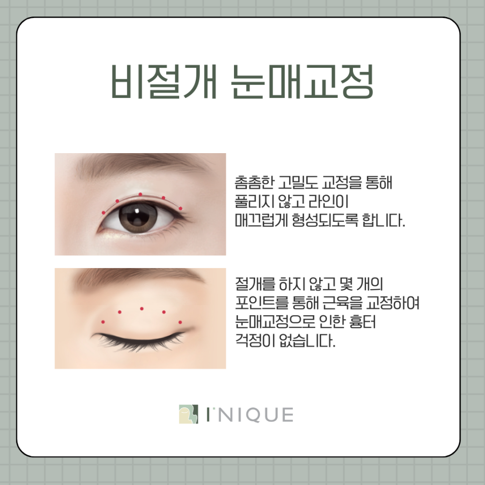 강남 눈매교정 이렇게 하면 자연스러워요 관련 이미지 6