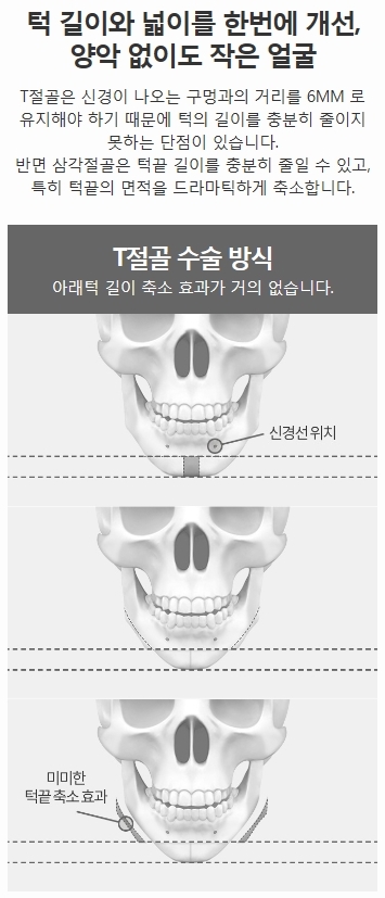 T절골수술 안전하게 갸름해지는 법 관련 이미지 3