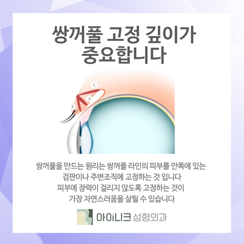 청담동 쌍꺼풀수술 추천 흉터를 줄이는 방식 관련 이미지 7
