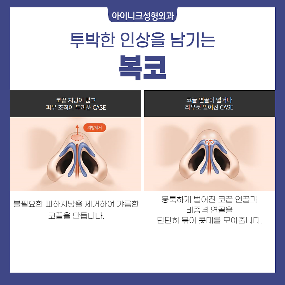 투박한 인상을 바꾸고 싶다면, 복코성형! 관련 이미지 3