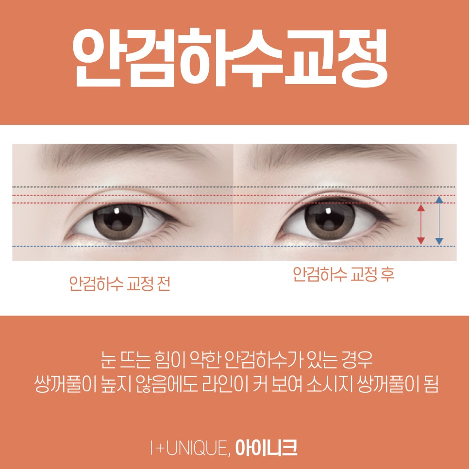 눈성형추천 아이니크성형외과에서 알려주는 수술방법 관련 이미지 4
