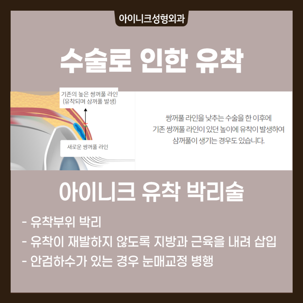 겹쌍꺼풀 해결방법, 원인에 따른 플랜이 필요해요! 관련 이미지 5