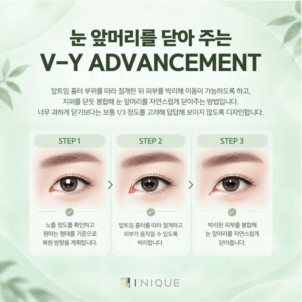 눈성형잘하는곳, 원인에 맞는 재수술 계획을 세우는 게 중요해요 관련 이미지 5