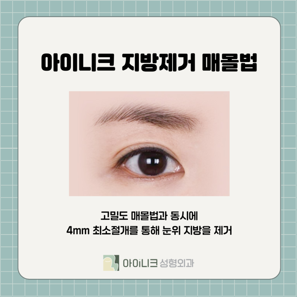 강남눈성형 자연스럽게 하려면 관련 이미지 8