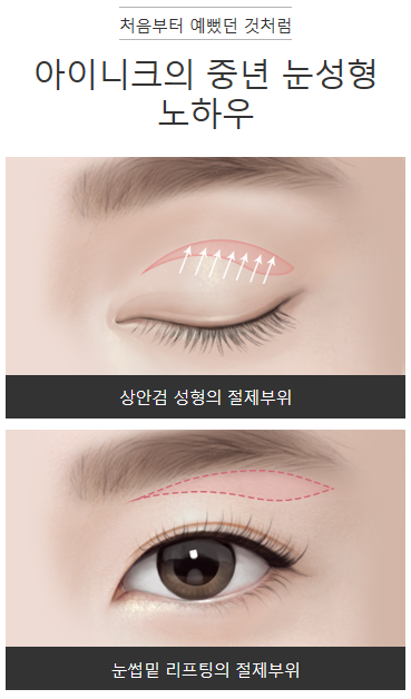 눈썹거상술 필요하신가요? 관련 이미지 3