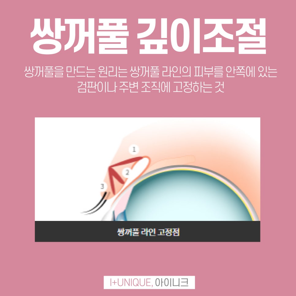 성형외과재수술을 알아보고 있다면 이젠 결정하자 아이니크로! 관련 이미지 5