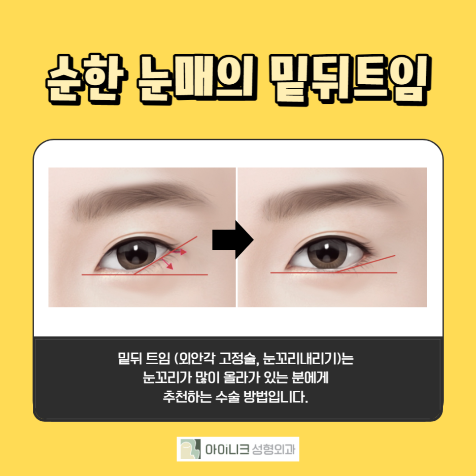 뒷트임밑트임 하기 전 조심해야 할 것은? 관련 이미지 4