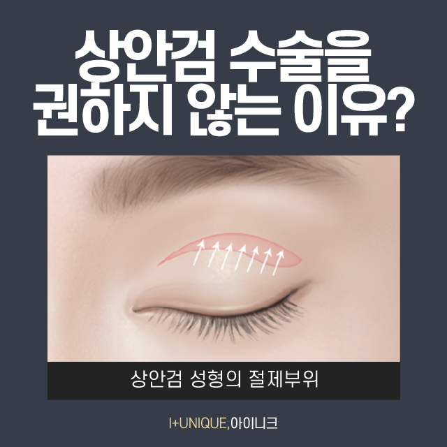 나! 다시 돌아갈래~ 중년 눈 성형, 눈썹거상술 관련 이미지 3