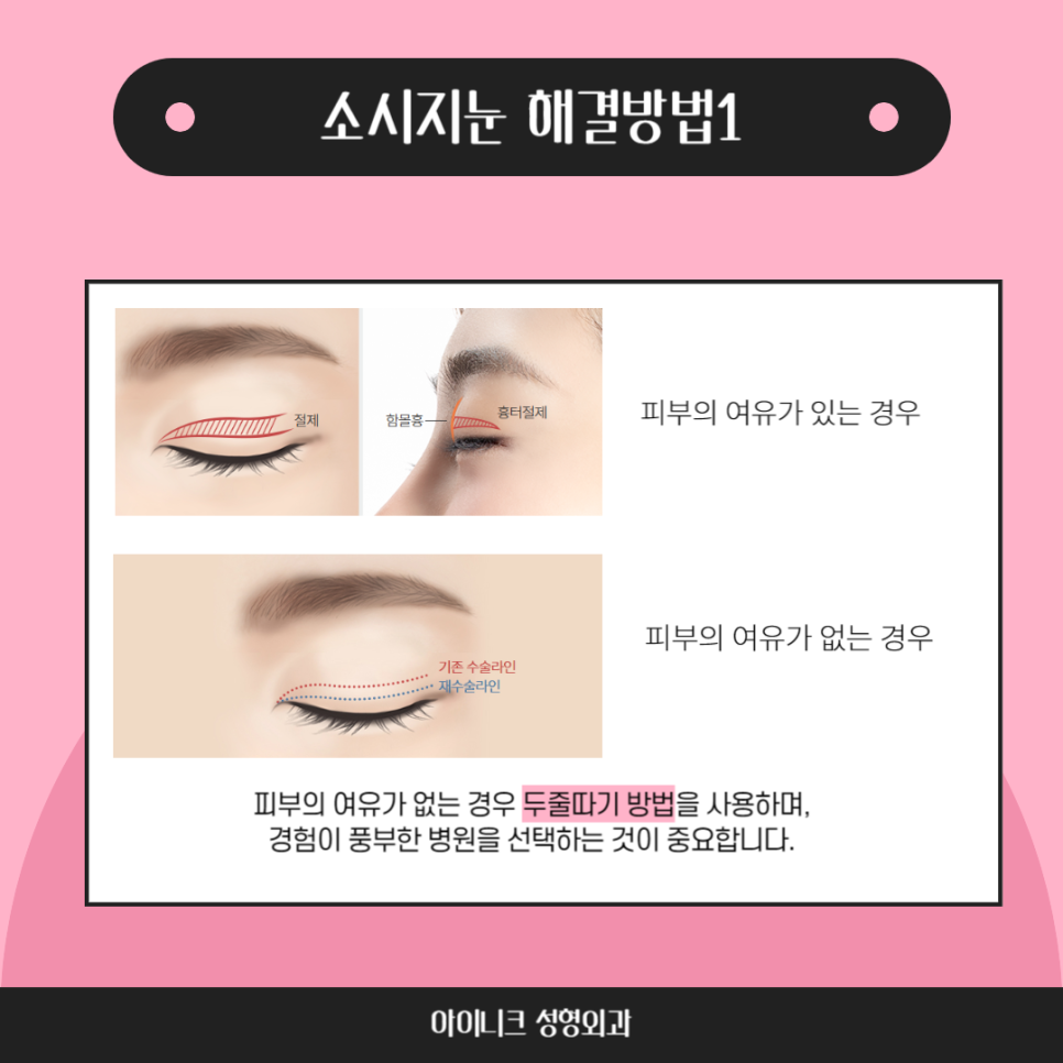 쌍꺼풀재수술병원, 실패없는 재수술을 위해 관련 이미지 3
