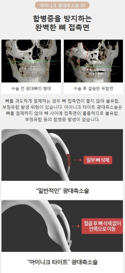 광대뼈축소부작용 없이 자연스러운 내 얼굴! 관련 이미지 6