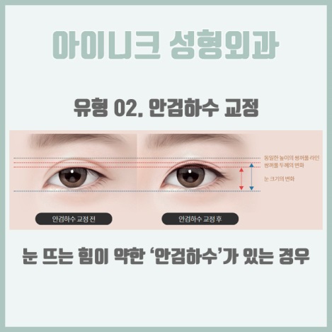 쌍커플재수술비용 원인별 맞춤 솔루션 제공! 관련 이미지 5