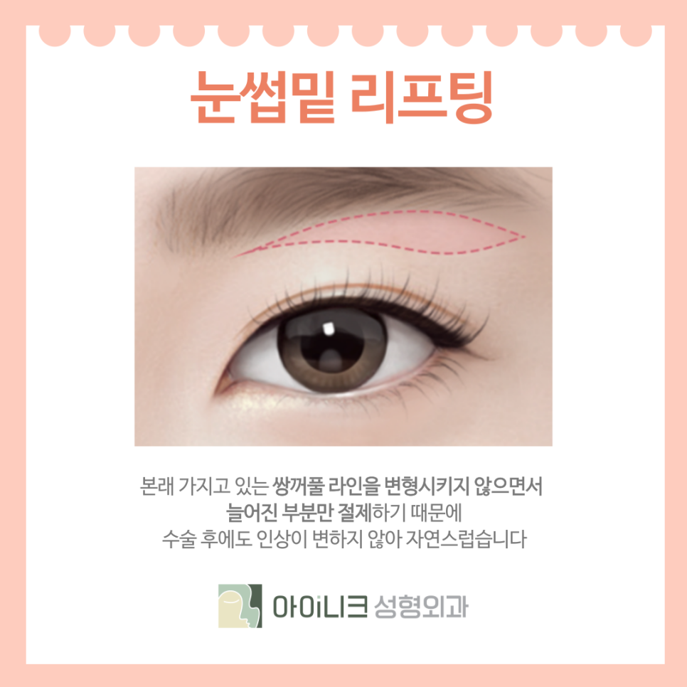 How to Turn Back Time with Eyelid Revision Surgery in Seoul for Middle-Aged Patients image 5