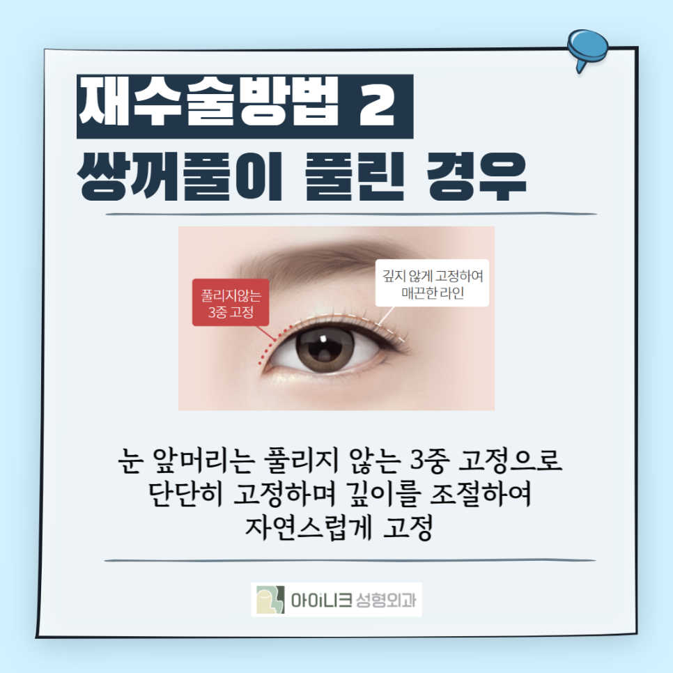 겹쌍꺼풀수술이고민이라면? 관련 이미지 5