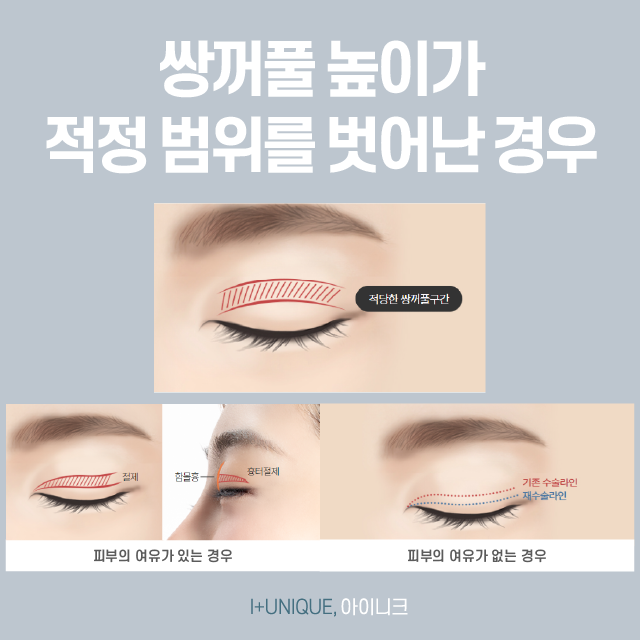 실패 걱정은 이제 그만! 눈성형재수술, 한 번에 끝내자!! 관련 이미지 3