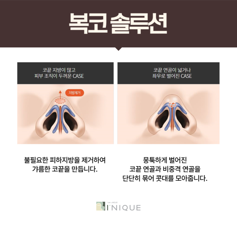 복코성형외과 여기서 성공 관련 이미지 5