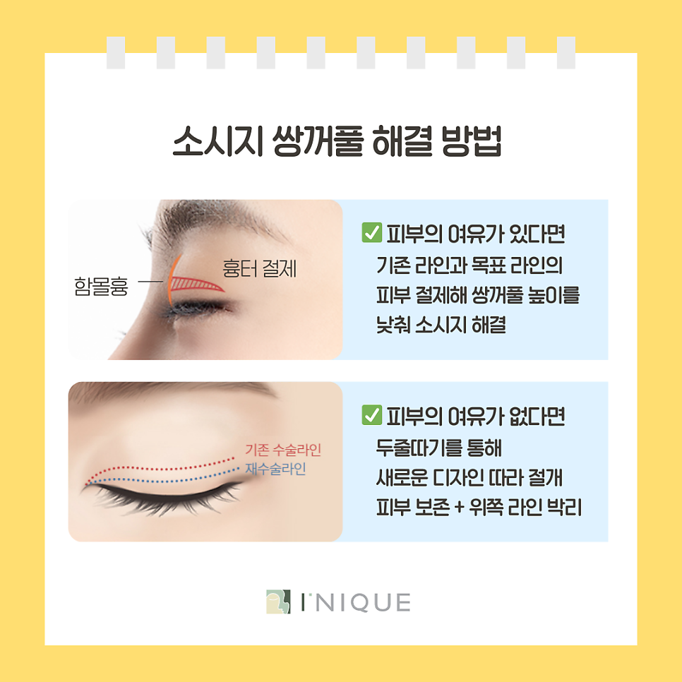 압구정 눈재수술 결정하기 전 꼭 체크할 네가지! 관련 이미지 6