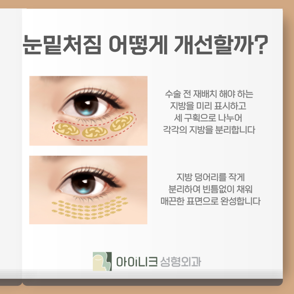 Reducing Bruising and Damage with the Under-Eye Laser Encore Ultrapulse image 7