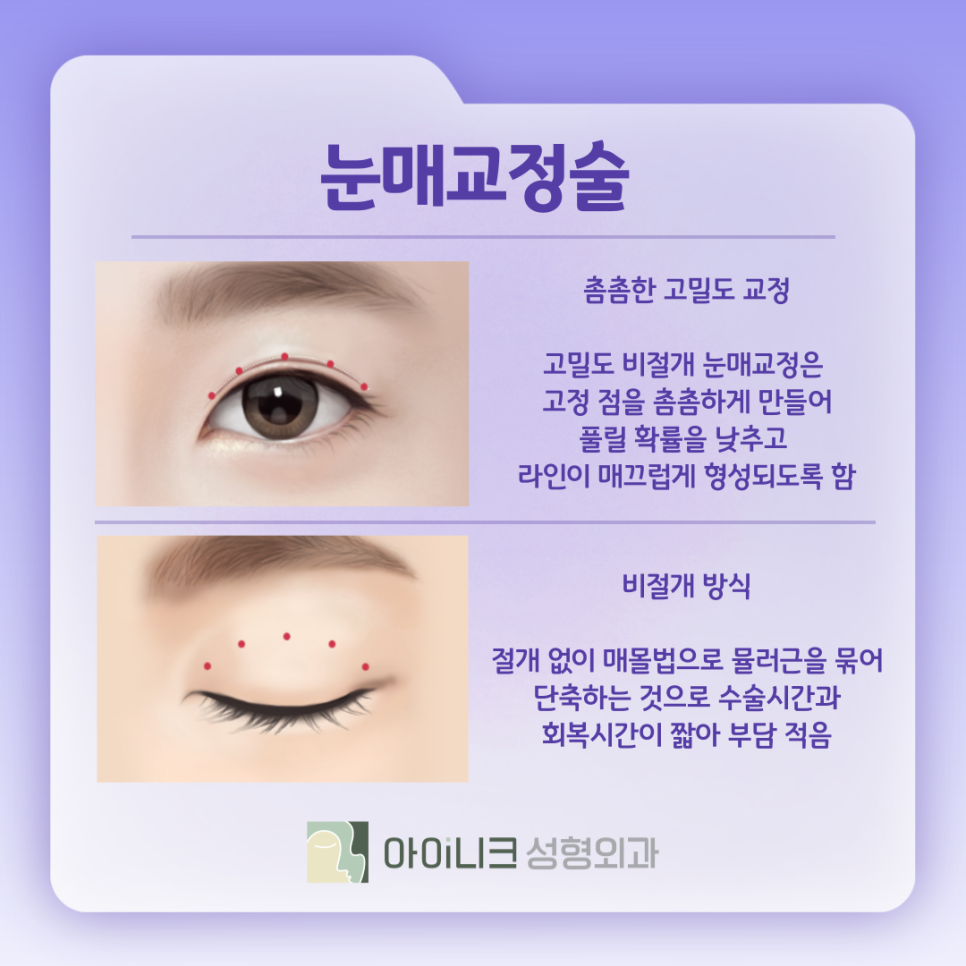 눈수술종류 내게 맞는 방법은 무엇? 관련 이미지 6