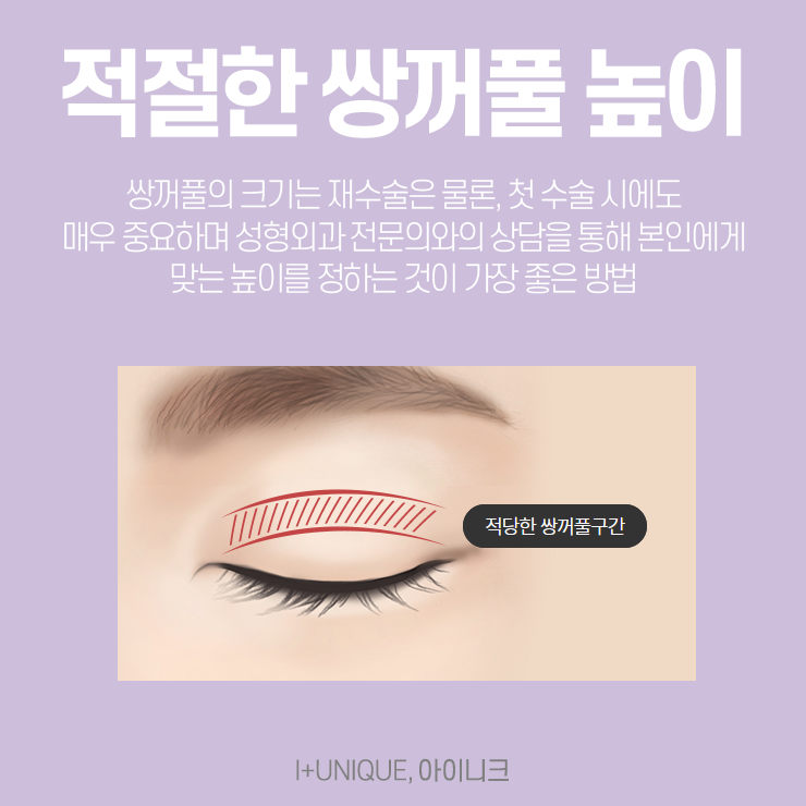 쌍꺼풀재수술잘하는병원, 아이니크성형외과 관련 이미지 3
