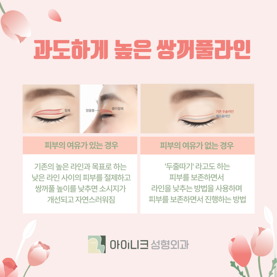 눈성형재수술 성공적으로 하기 위해서는? 관련 이미지 4