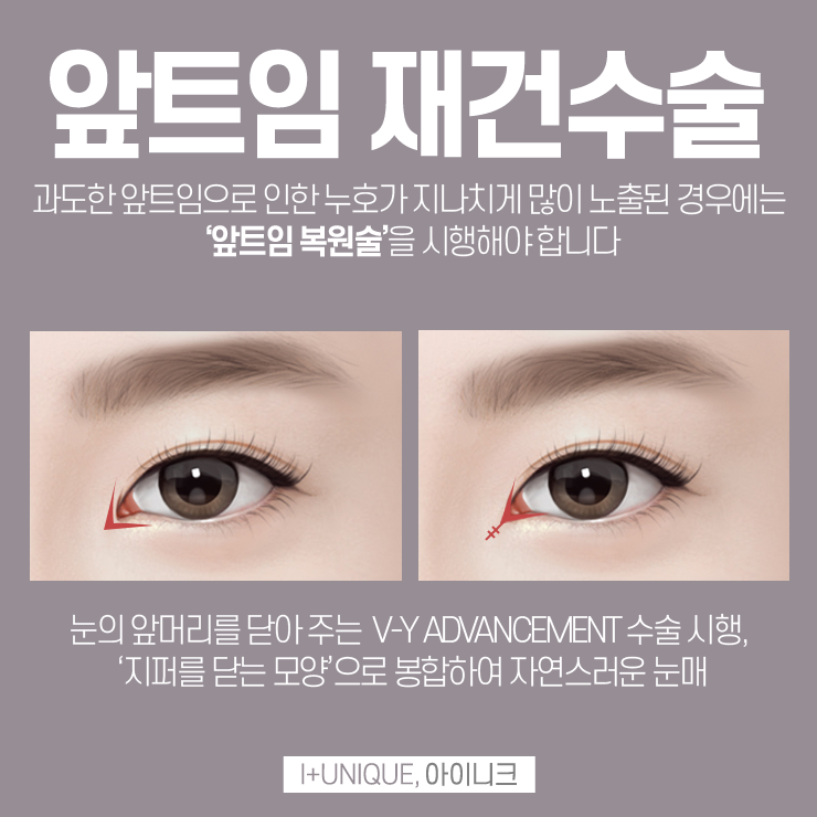 아이니크성형외과에서 트임재수술로 다시 또렷하게 관련 이미지 3