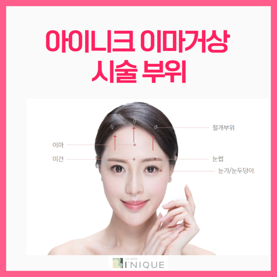 엔도타인이마거상, 흉터는 적게 리프팅은 확실하게! 관련 이미지 2