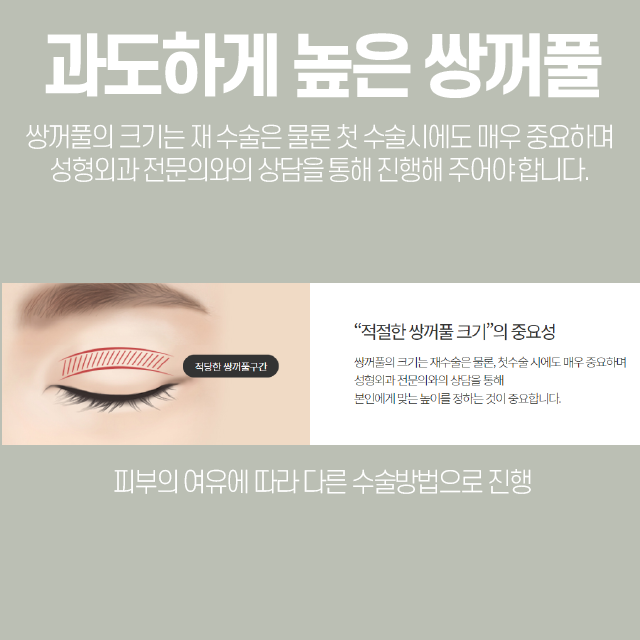 눈재수술병원을 알아보고 있다면, 신중해야 하는 이유 관련 이미지 3