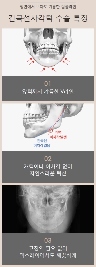 사각턱재건 실패 없이 완성된 얼굴 관련 이미지 6