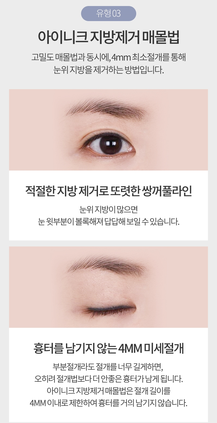 쌍꺼풀절개법전후 비교해보고 결정하세요! 관련 이미지 5