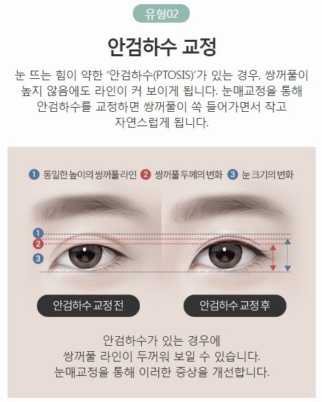 쌍커풀라인낮추기 아이니크 소시지 눈 재수술로 해결! 관련 이미지 4